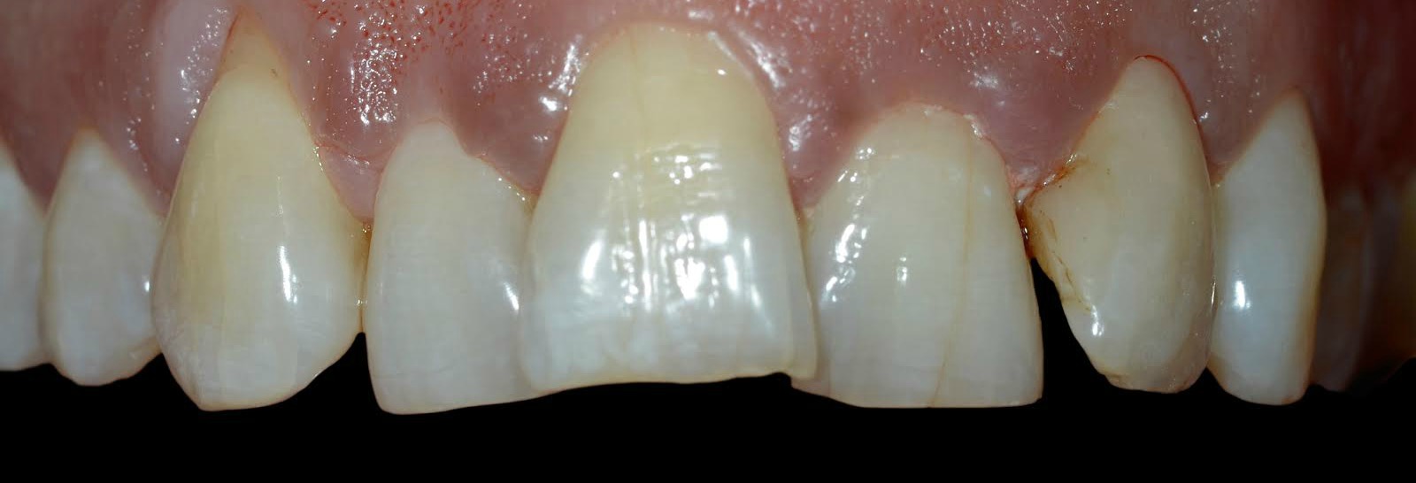 Cosmetic Veneers Dentist Remuera The Oral Care Company